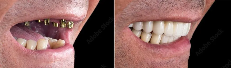 All-on-X Dental Implants - Before and After