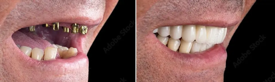 All-on-X Dental Implants - Before and After