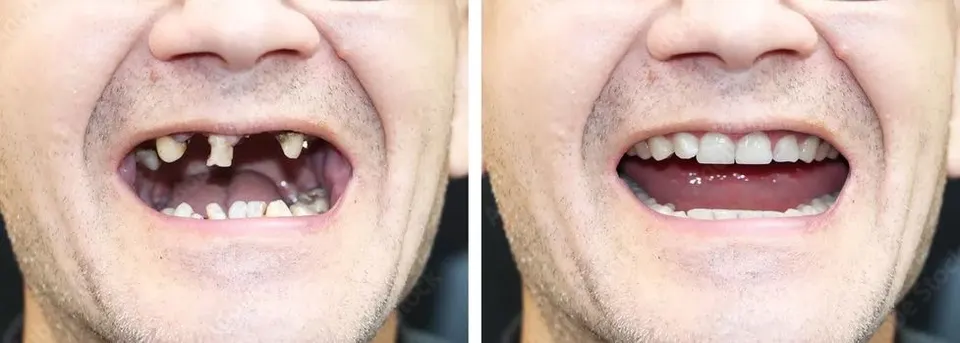 All-on-X Dental Implants - Before and After