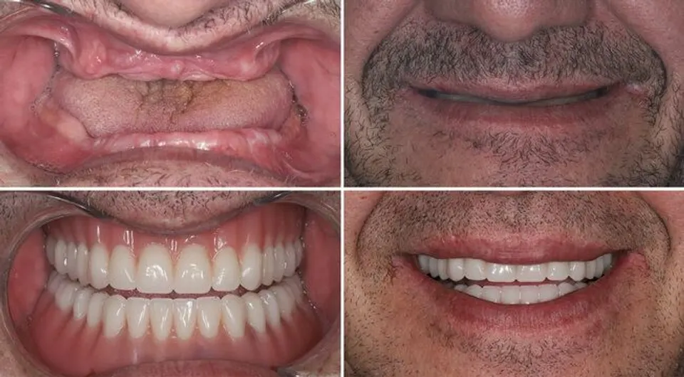 All-on-X Dental Implants - Before and After