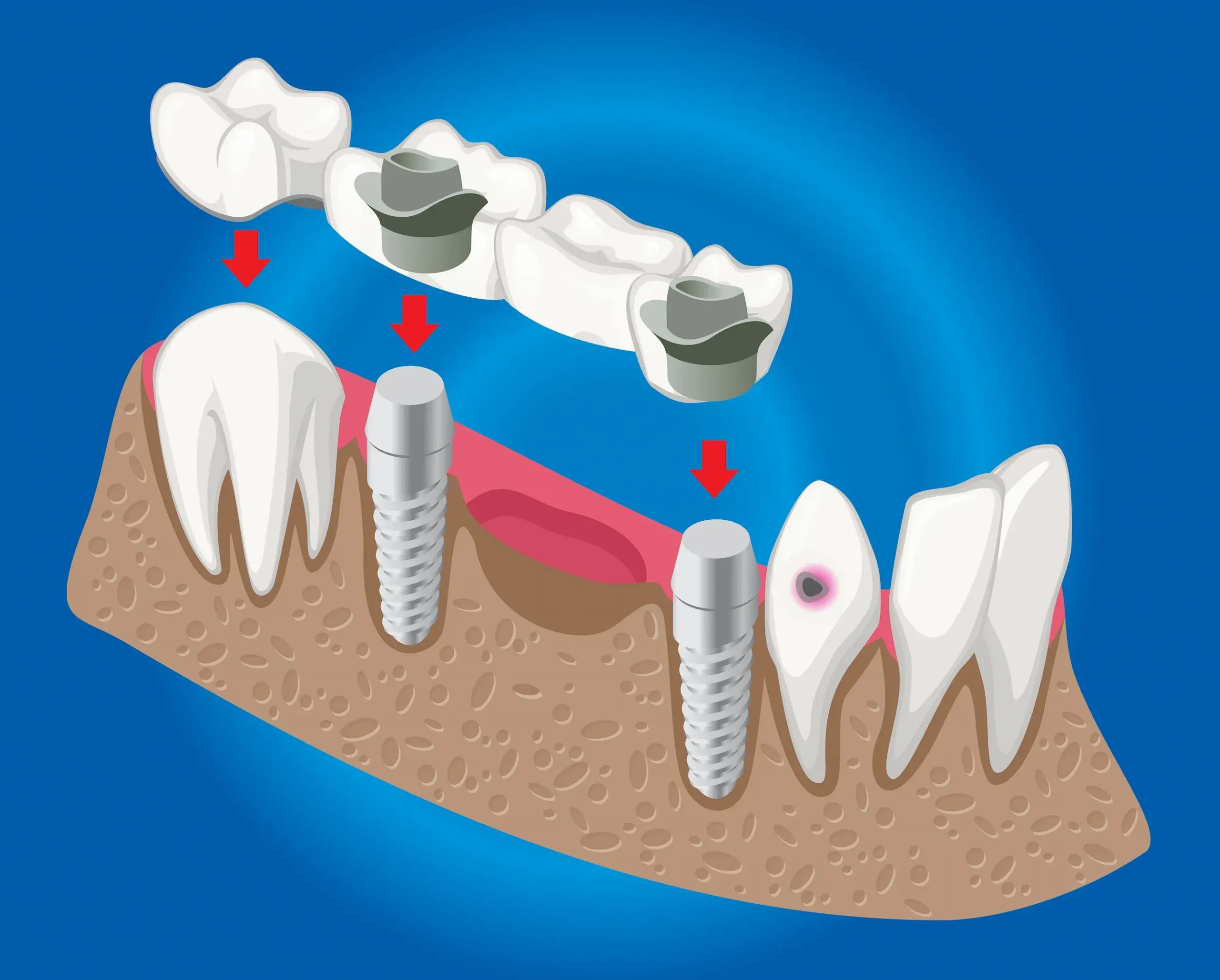 Implant bridge procedure at Dental World in Longwood Florida