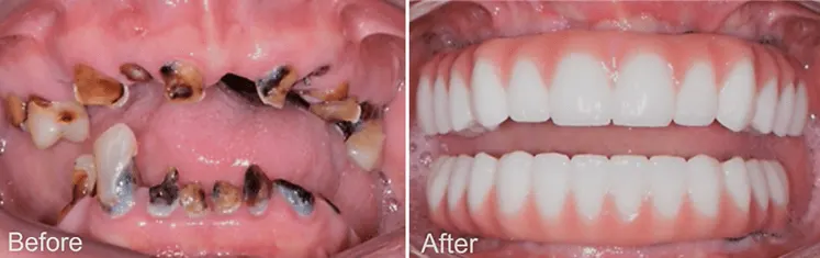 All-on-X Dental Implants - Before and After