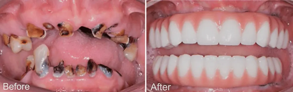 All-on-X Dental Implants - Before and After