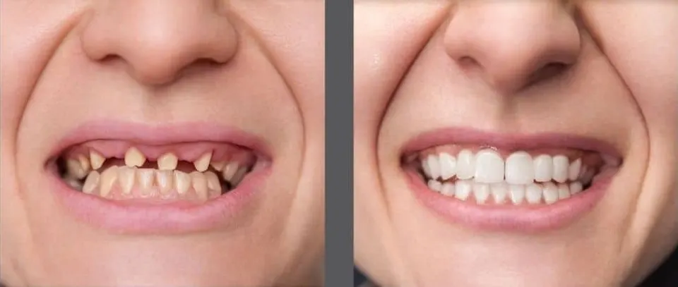 All-on-X Dental Implants - Before and After