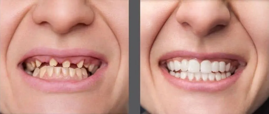 All-on-X Dental Implants - Before and After