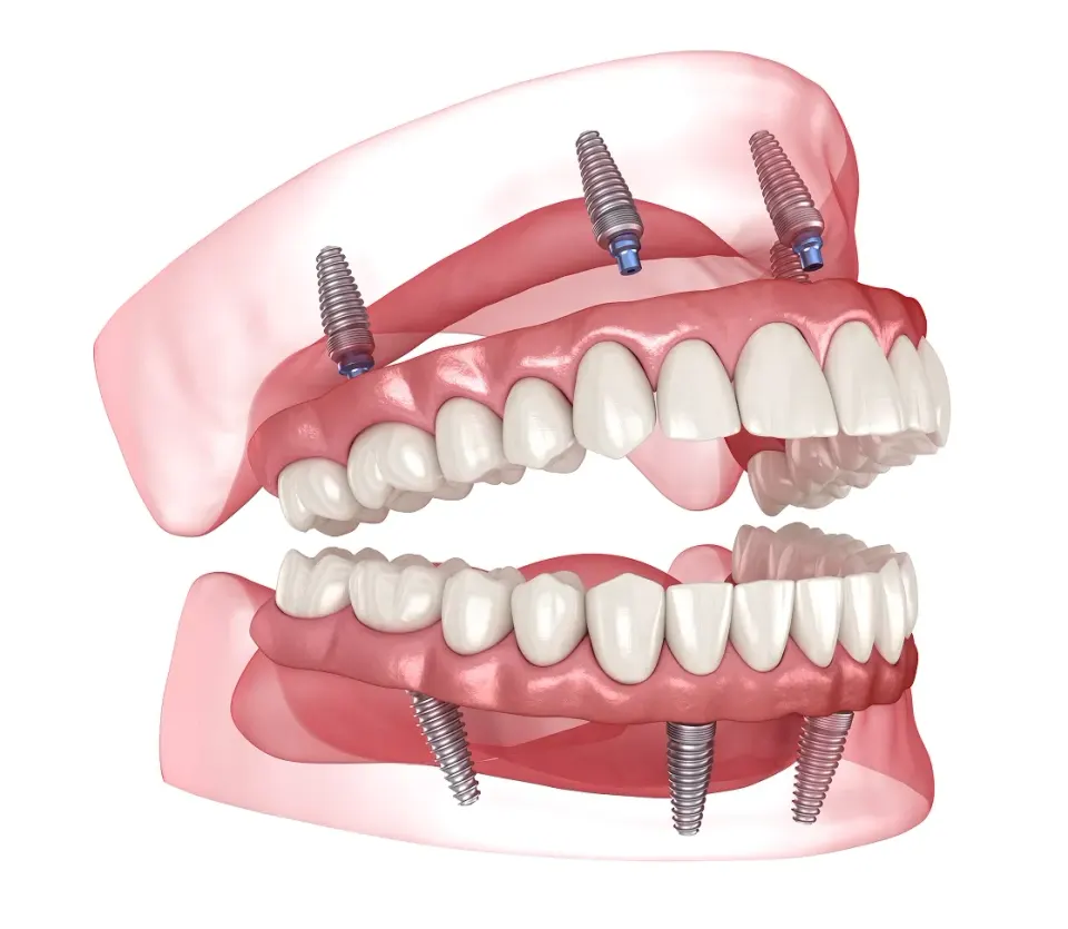 Benefits of All-on-X Implants