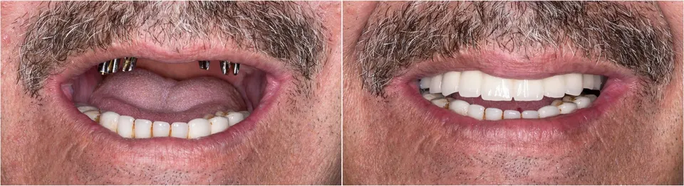 All-on-X Dental Implants - Before and After