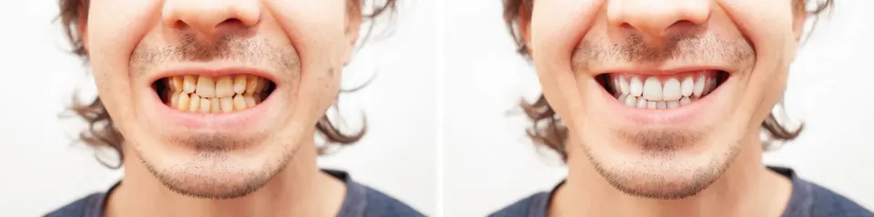 Clear Aligners - Before and After