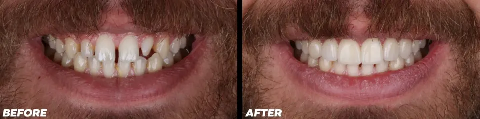 Clear Aligners - Before and After
