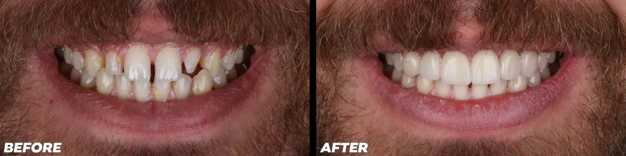 Clear Aligners - Before and After