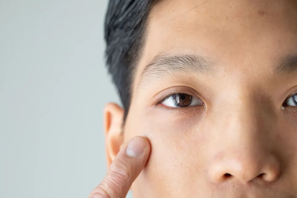Lifestyle factors affecting dark under-eye circles at Dental World Longwood Florida
