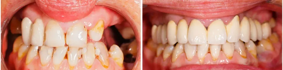 Dental Bridges - Before and After