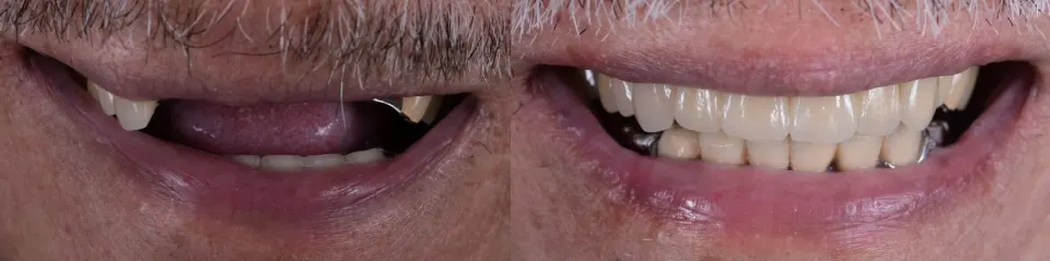 Dental Bridges - Before and After