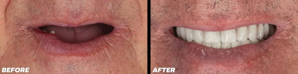 All-on-X Dental Implants - Before and After