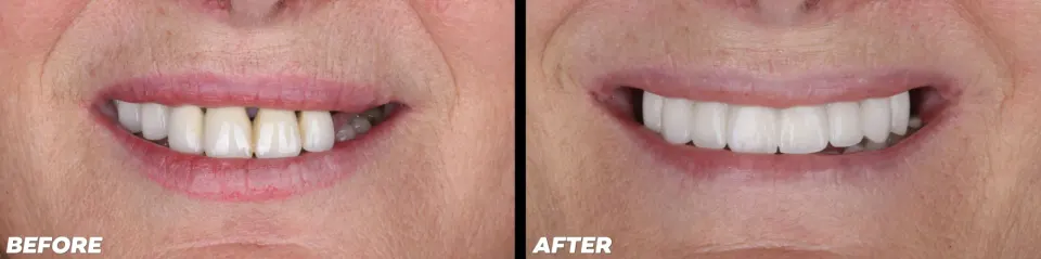 Dental Implants - Before and After