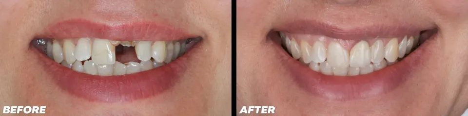 Dental Implants - Before and After