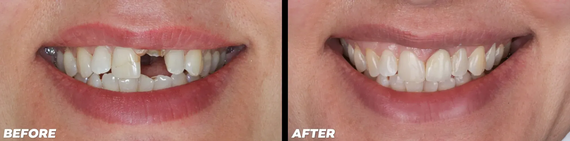 Dental Implants - Before and After