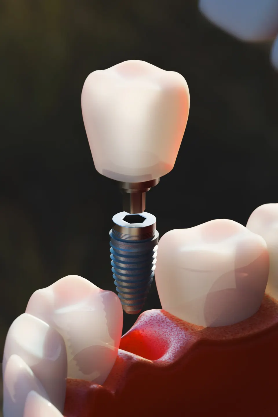 Patient discussing dental implant repair benefits with Dr. Manmode at Dental World Longwood