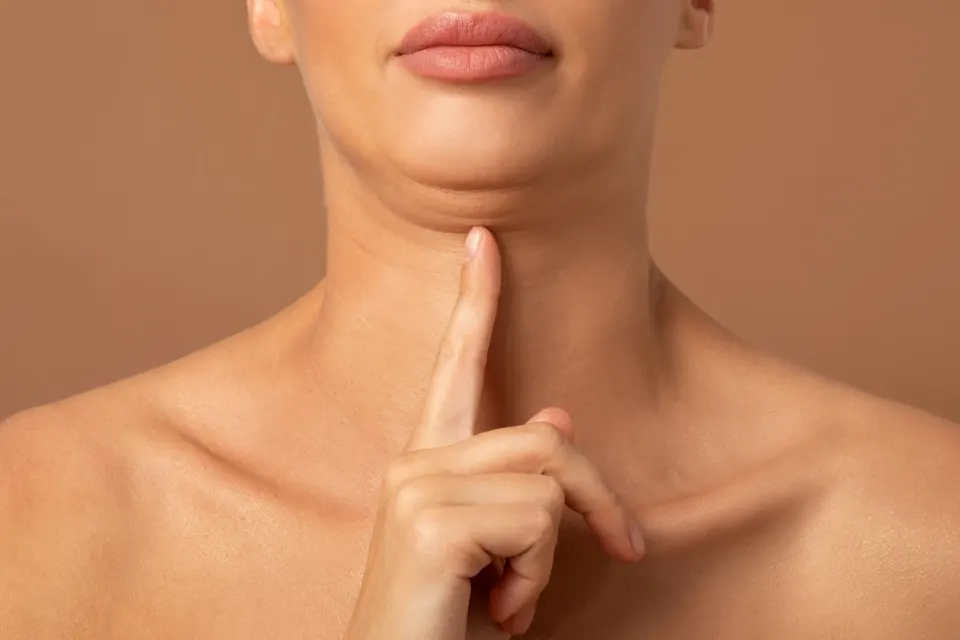 Diagram showing submental fat versus skin laxity at Dental World Longwood