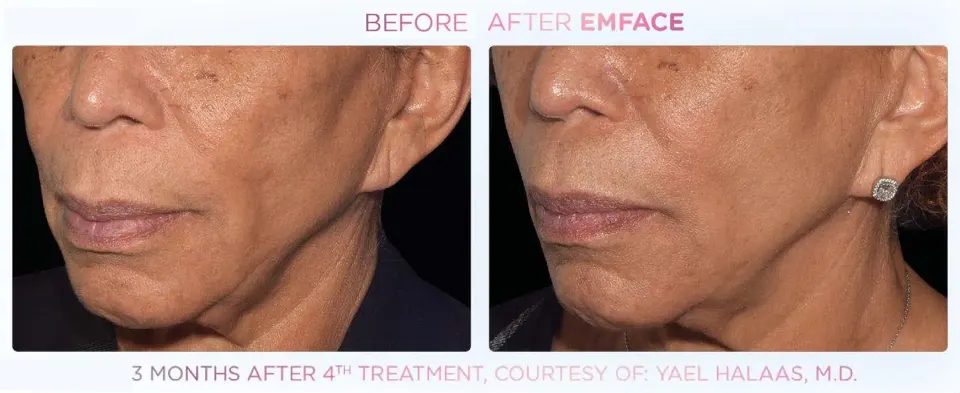 Emface effect on the cheeks