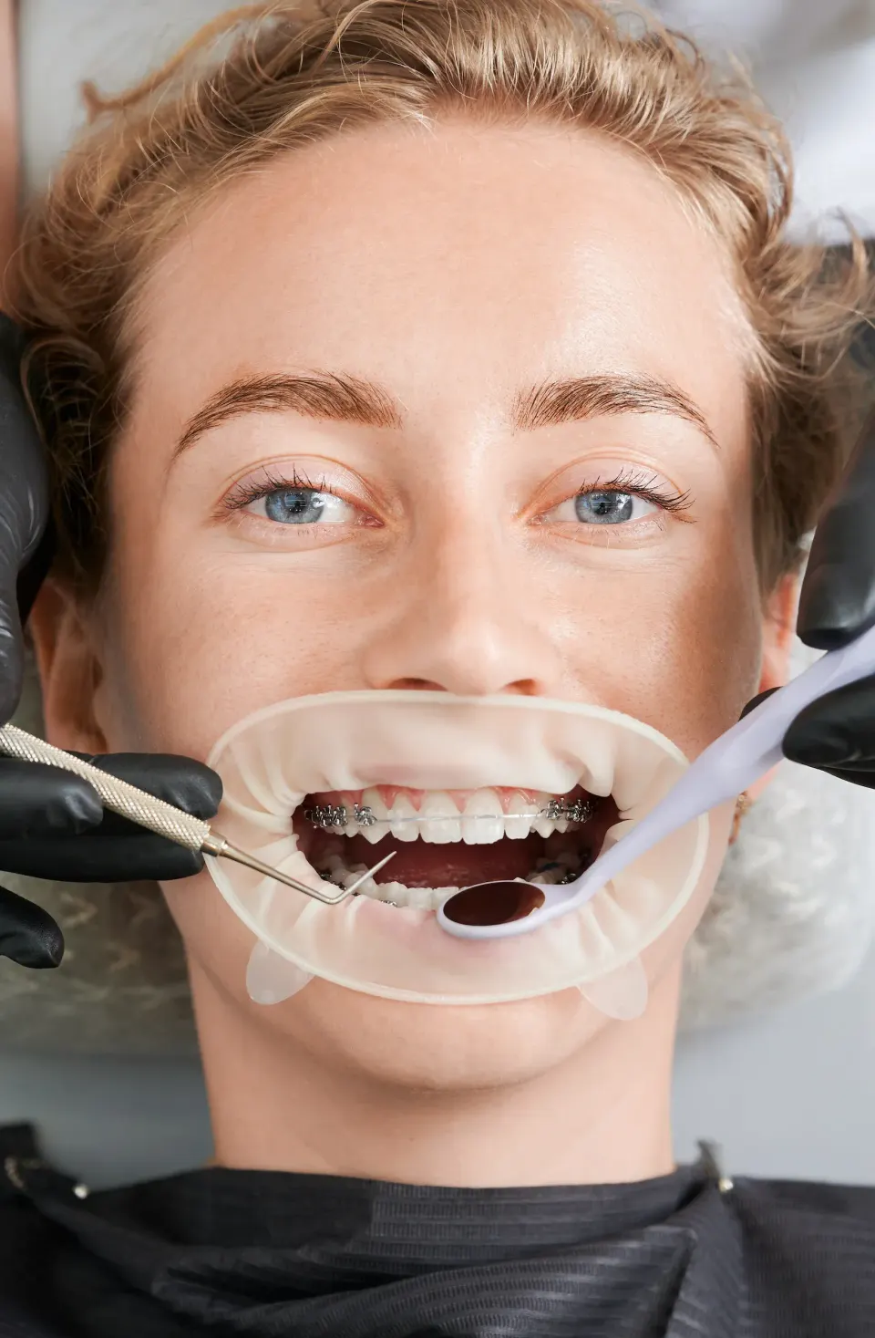 Composite resin filling materials used at Dental World Longwood