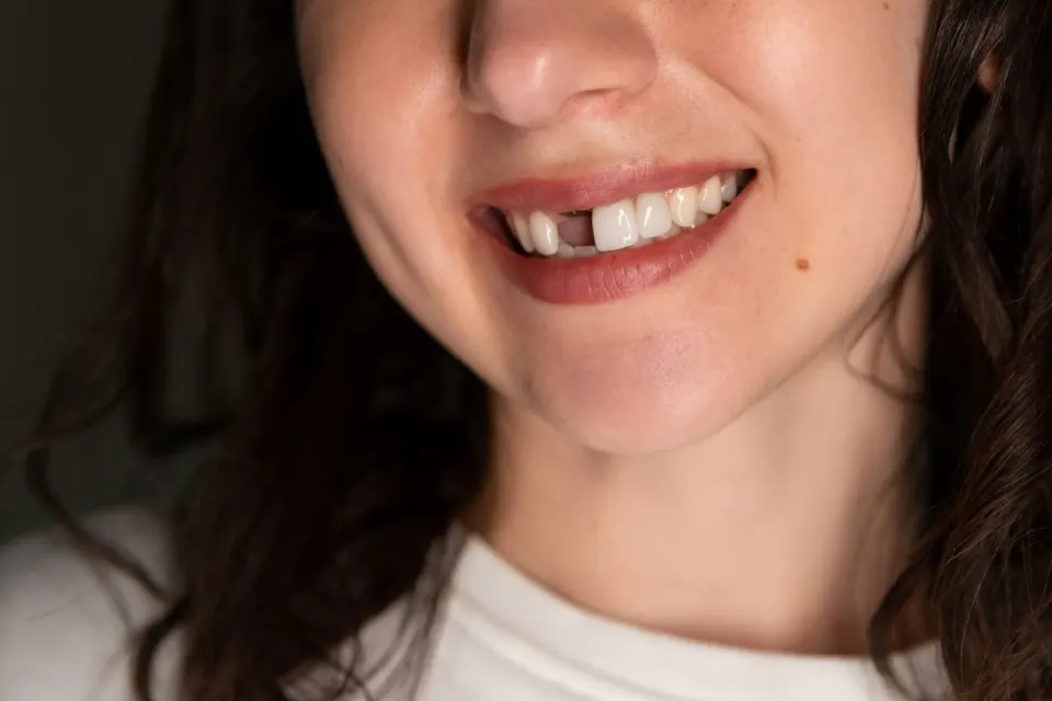 Patient smiling confidently after tooth replacement at Dental World Longwood