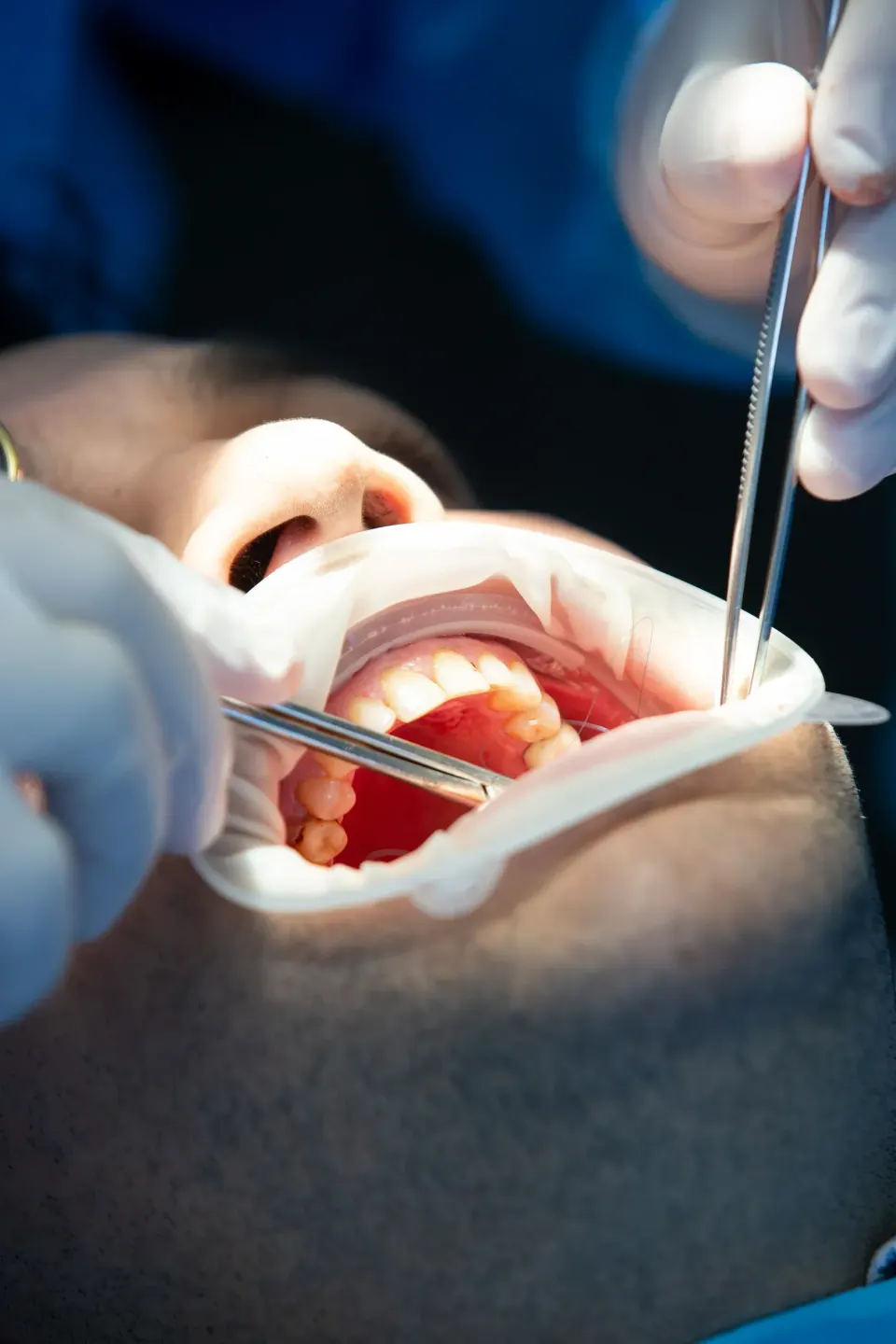 Patient consultation for tooth extraction at Dental World Longwood FL