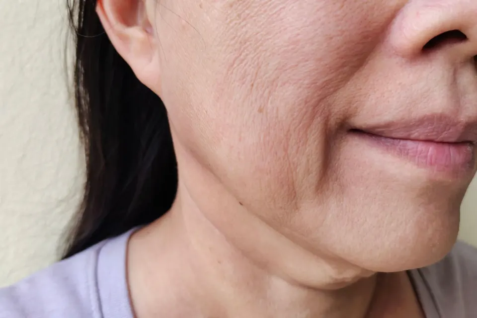 Lifestyle factors contributing to saggy skin at Dental World Longwood FL