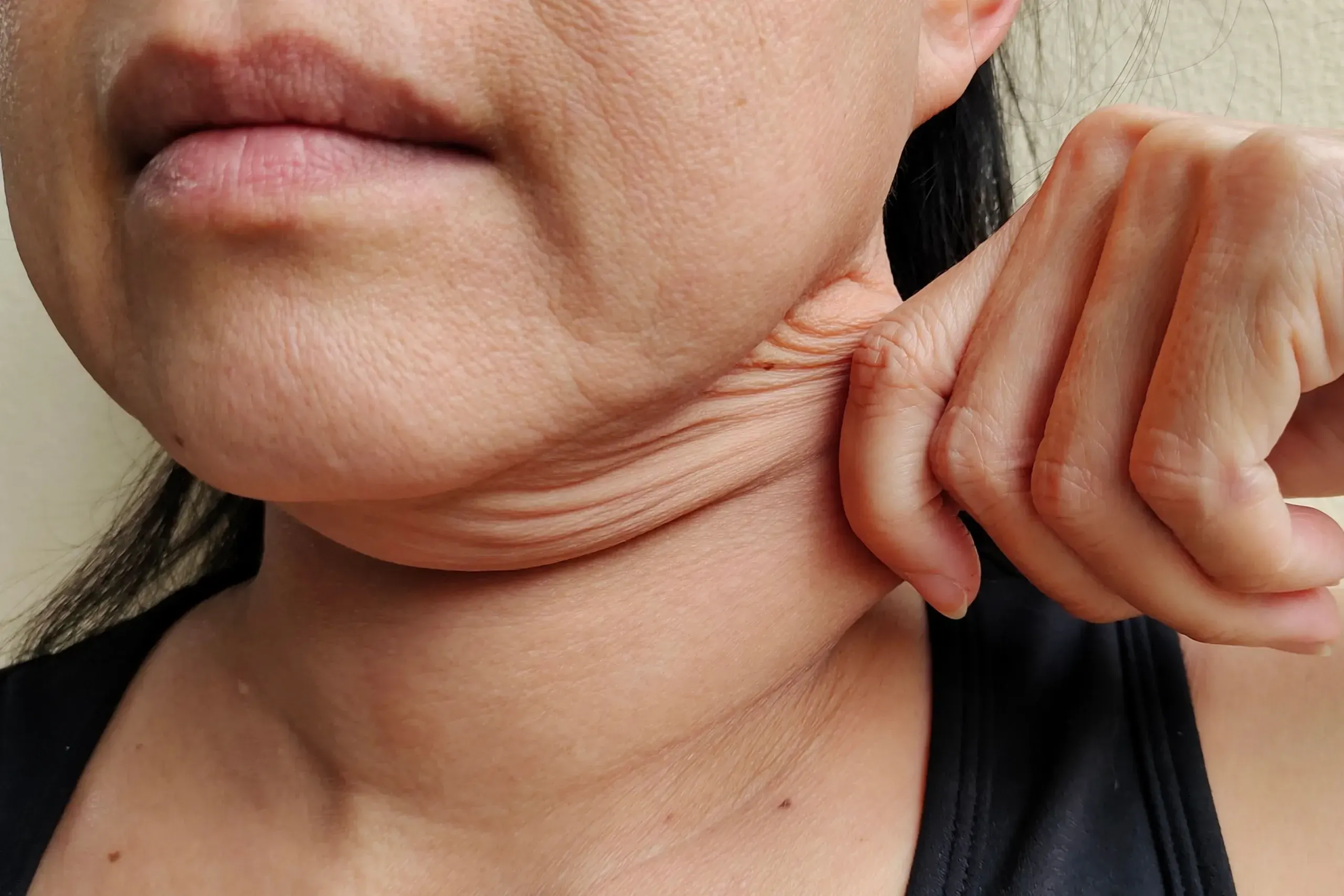 Woman with saggy skin along jawline seeking treatment at Dental World Longwood FL