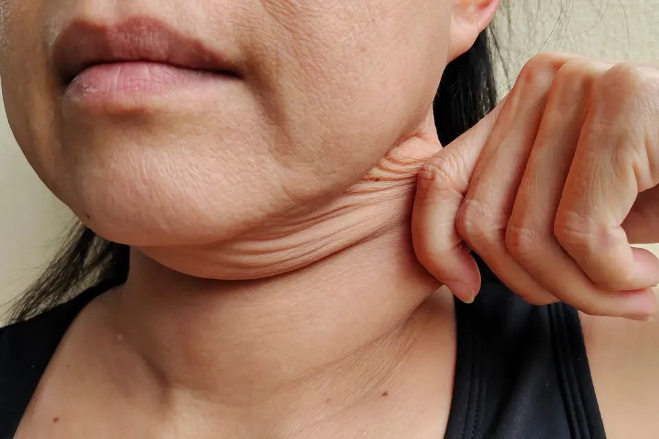 Woman with saggy skin along jawline seeking treatment at Dental World Longwood FL