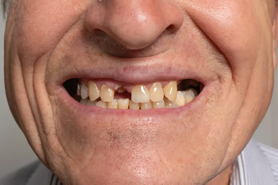 Lifestyle and dietary factors contributing to tooth fractures and looseness at Dental World Longwood