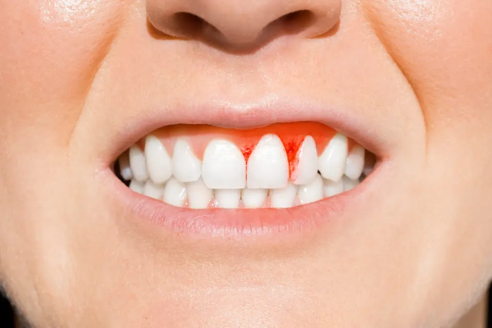 Lifestyle and health factors contributing to bleeding gums at Dental World Longwood FL