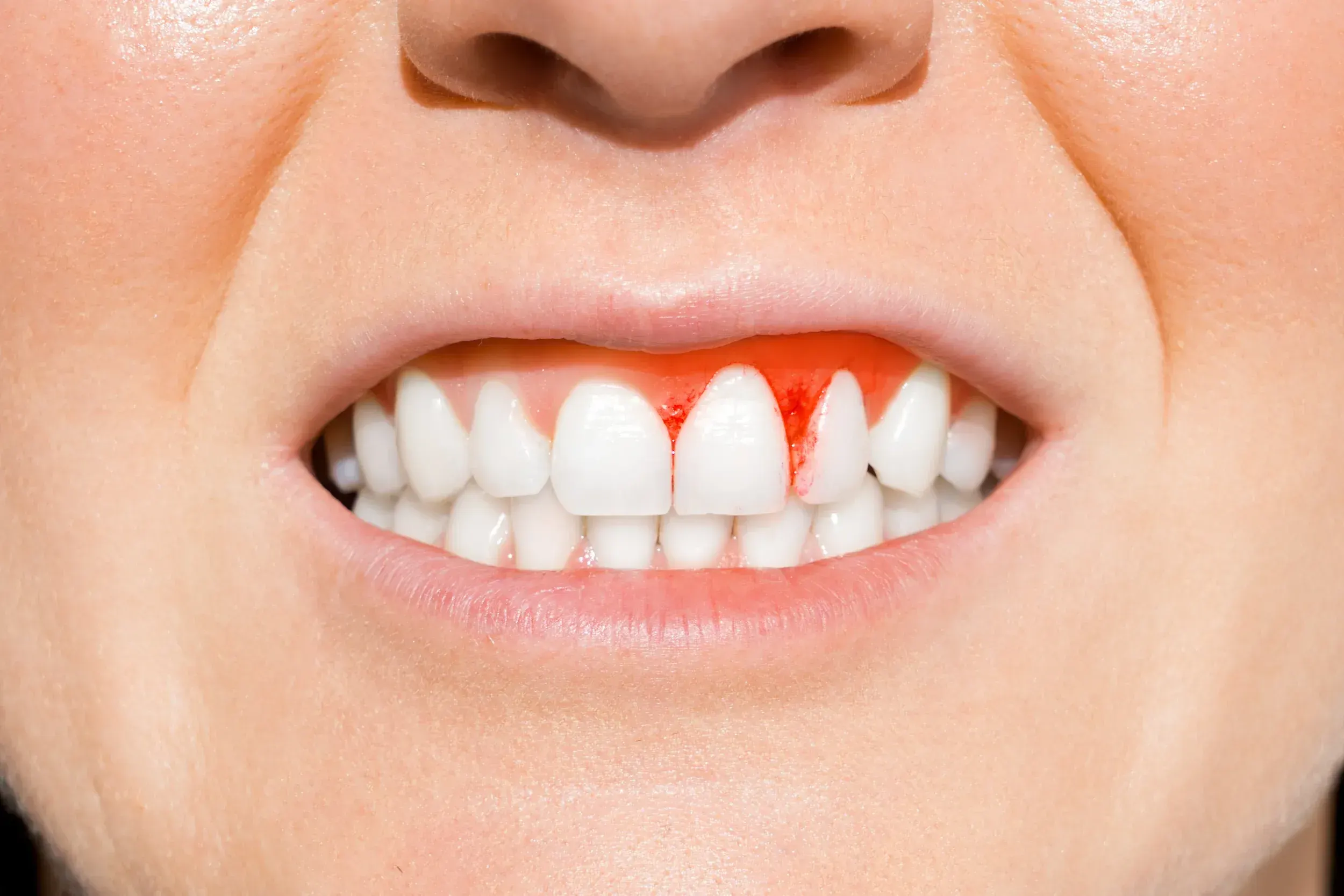 Lifestyle and health factors contributing to bleeding gums at Dental World Longwood FL
