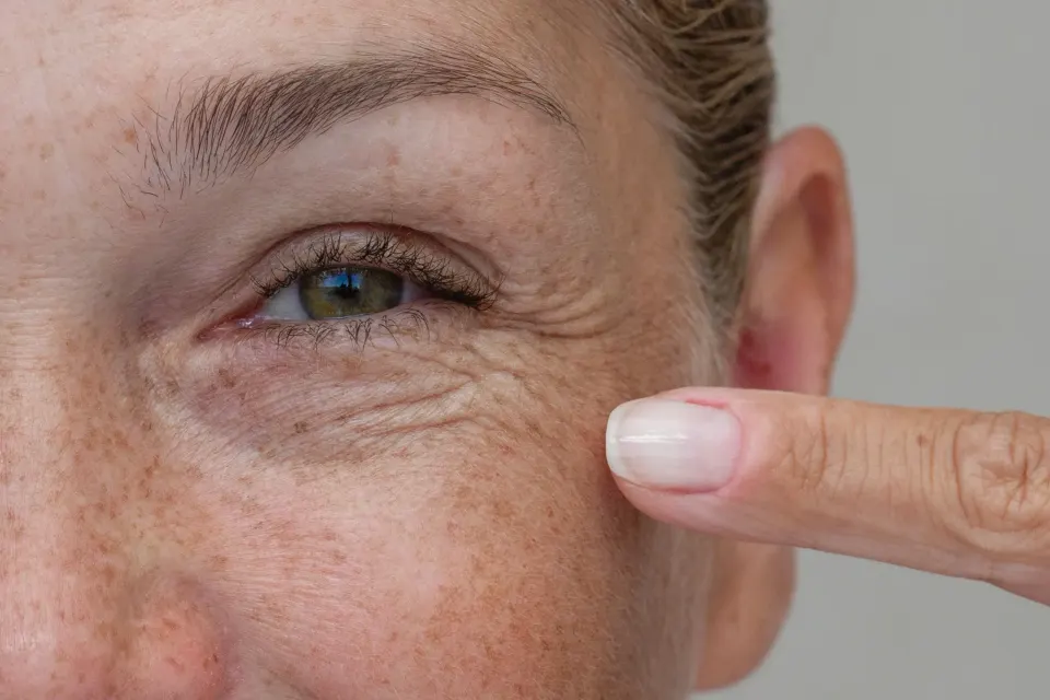 Close-up of facial wrinkles being assessed for treatment at Dental World Longwood FL