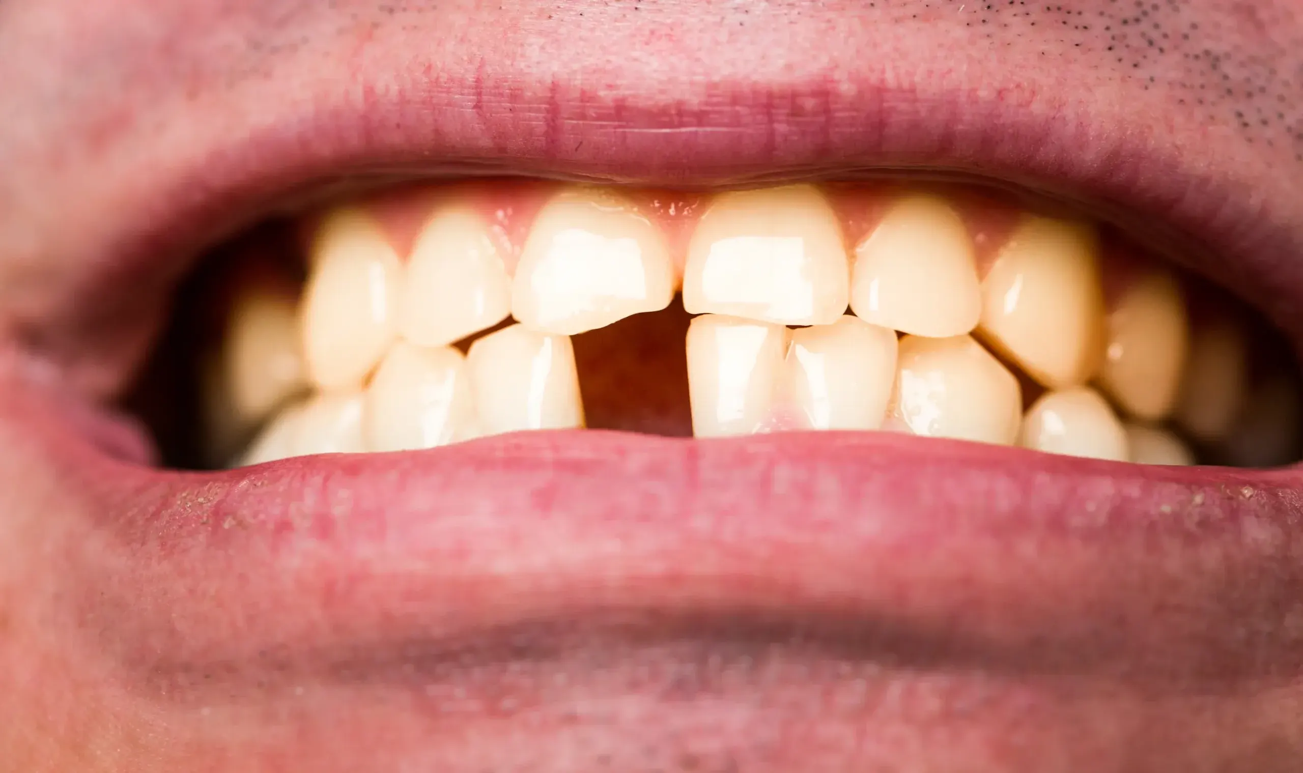 Patient with a broken tooth receiving dental evaluation at Dental World in Longwood FL
